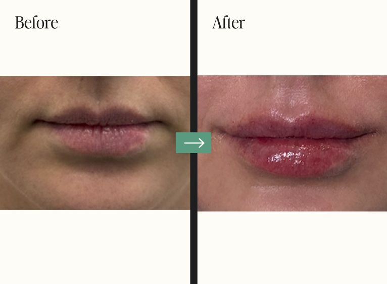Dermal Fillers Before and After Pictures Charleston, SC